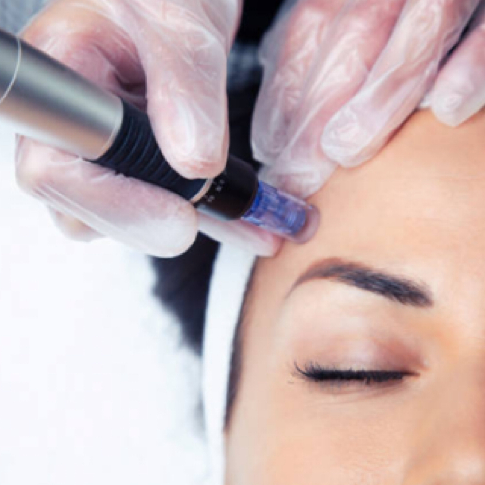 Microneedling | Collagen Induction at anasko skin studio in Dallas, TX