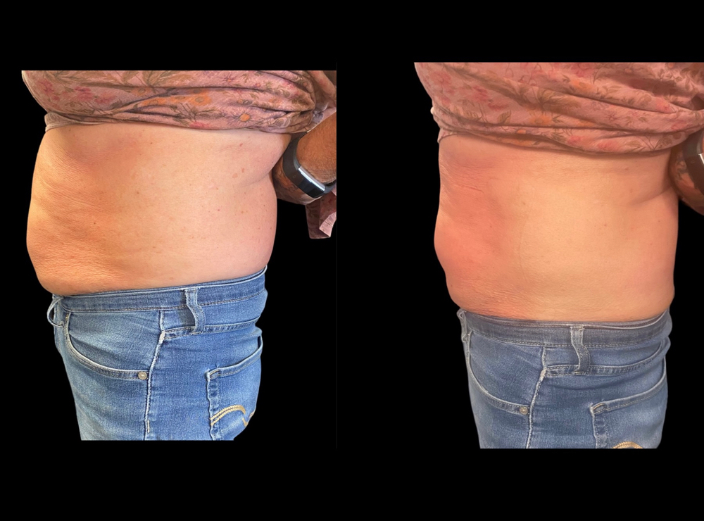 Basic Lipo Treatment