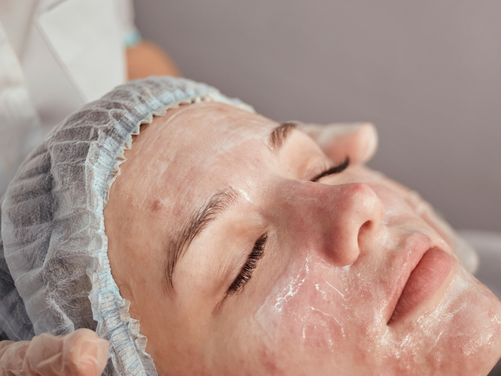 Acne Treatment at Dahlias Wellness Center in passaic, NJ