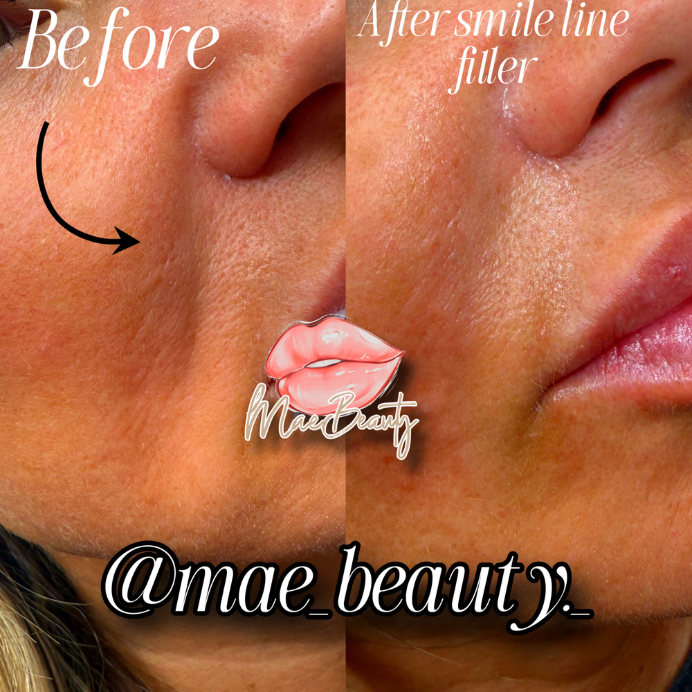 Smile Line Filler at MaeBeauty in Mesquite, TX