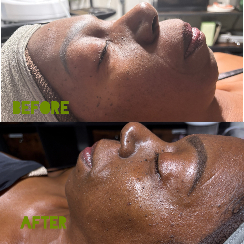 Advanced Corrective Facial