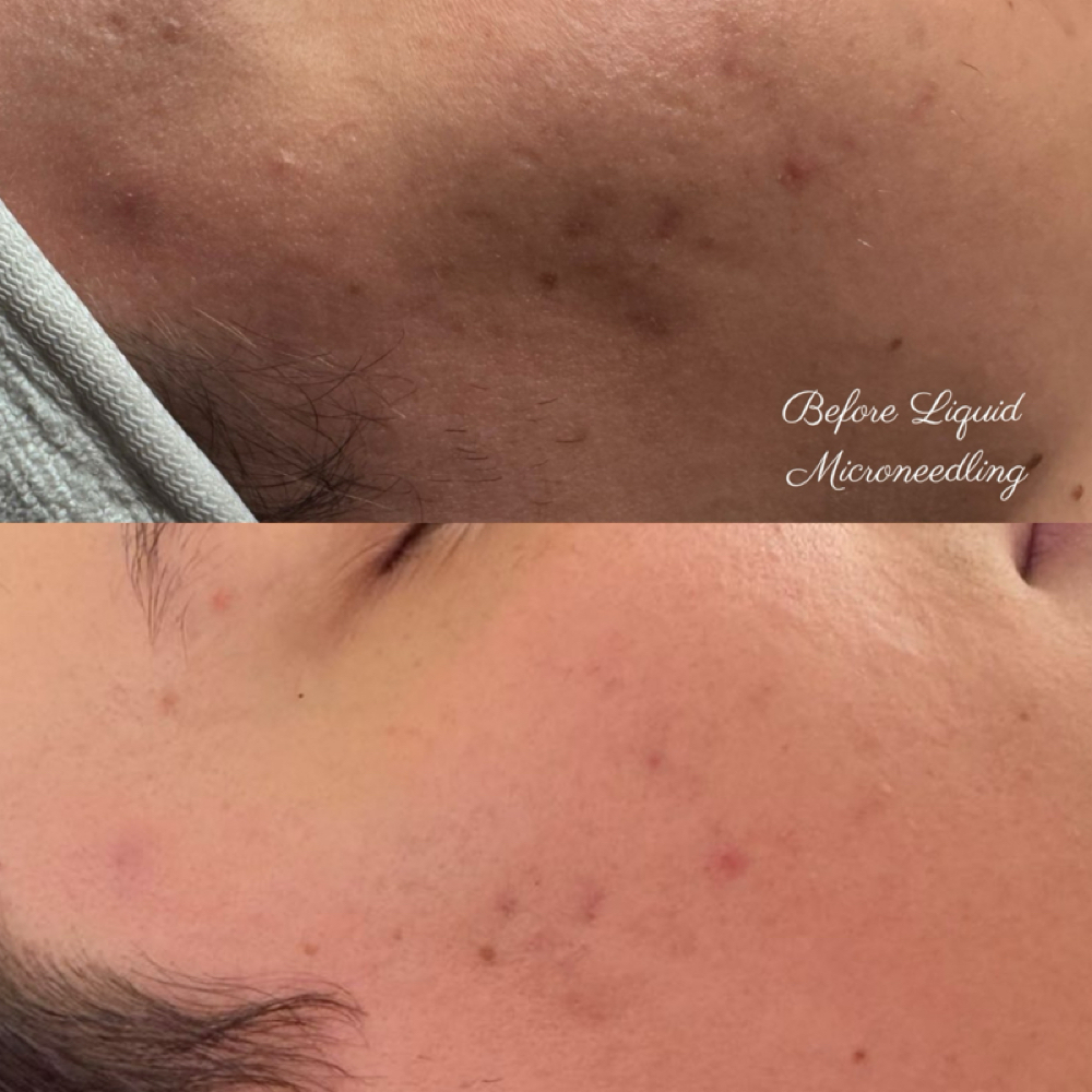 Korean Liquid Microneedling at The Hive Spa and Beauty Studio LLC in San Antonio, TX