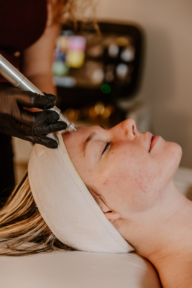 Microneedling