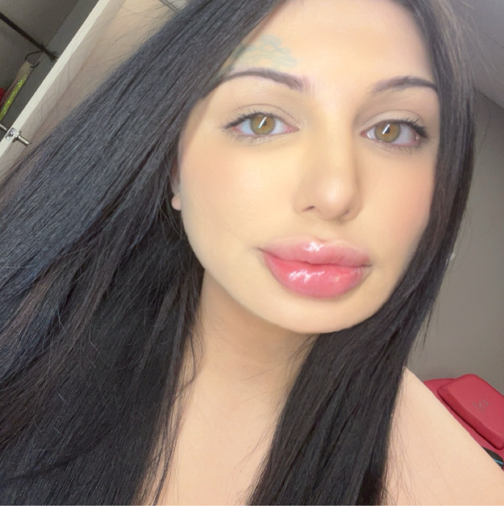 💎 Lip Filler – Full Syringe at Flawless Spa & Beauty in Fort Worth, TX