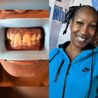 1 Hour Teeth Whitening at Dazzling Smilez Teeth Whitening in Warner Robins, GA