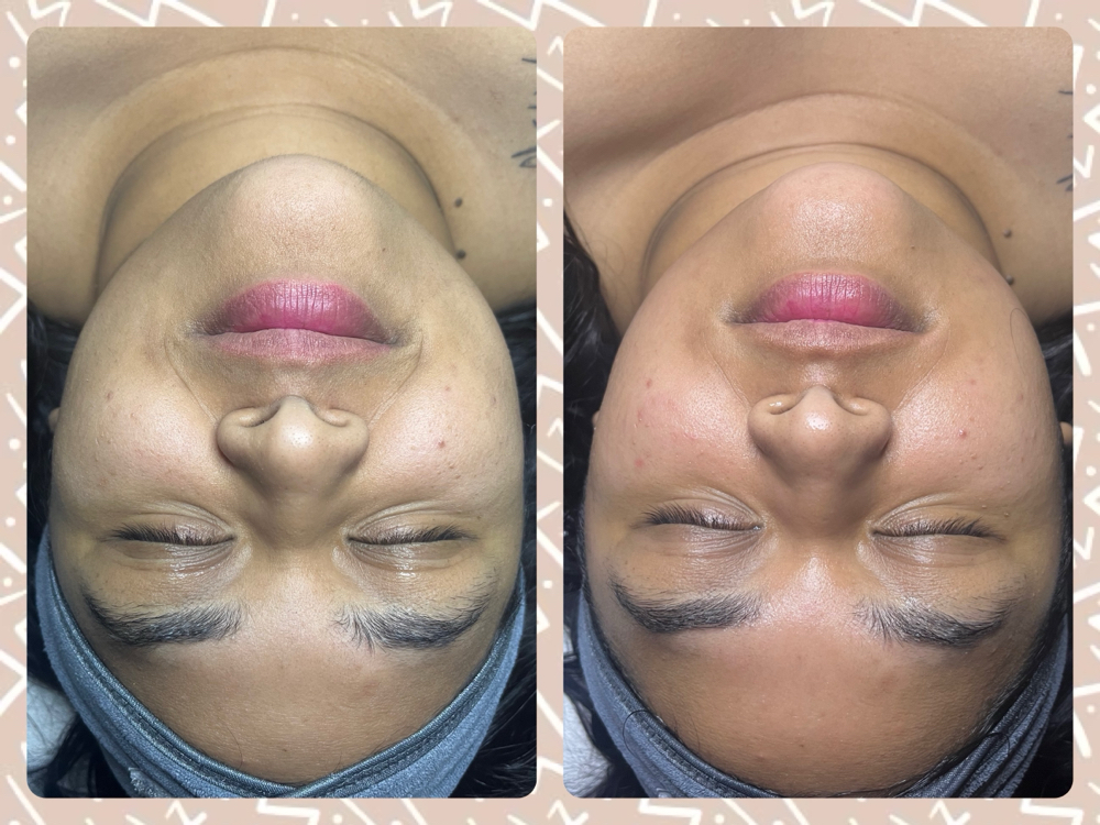 Dermaplane Facial