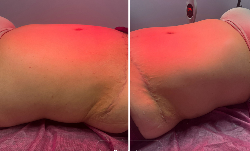 4 Post-Op Lymphatic Treatments at Lash & Body Studio, LLC in Houston, TX