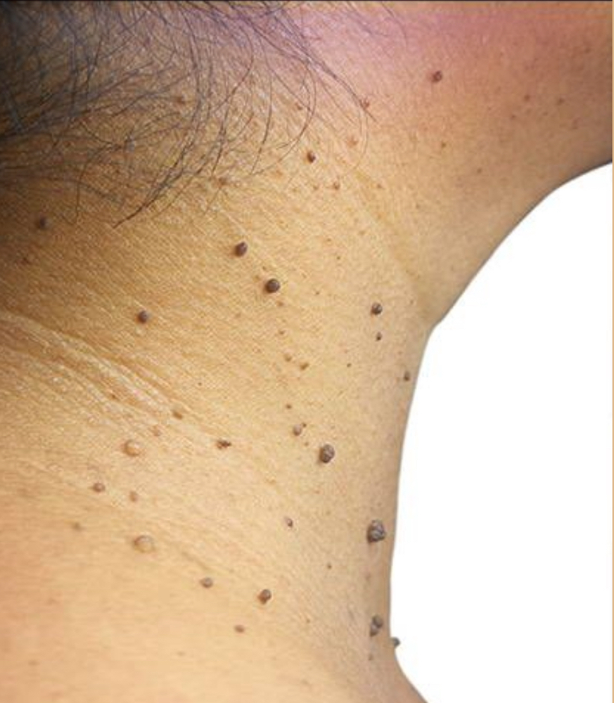 Skin Tags Removal