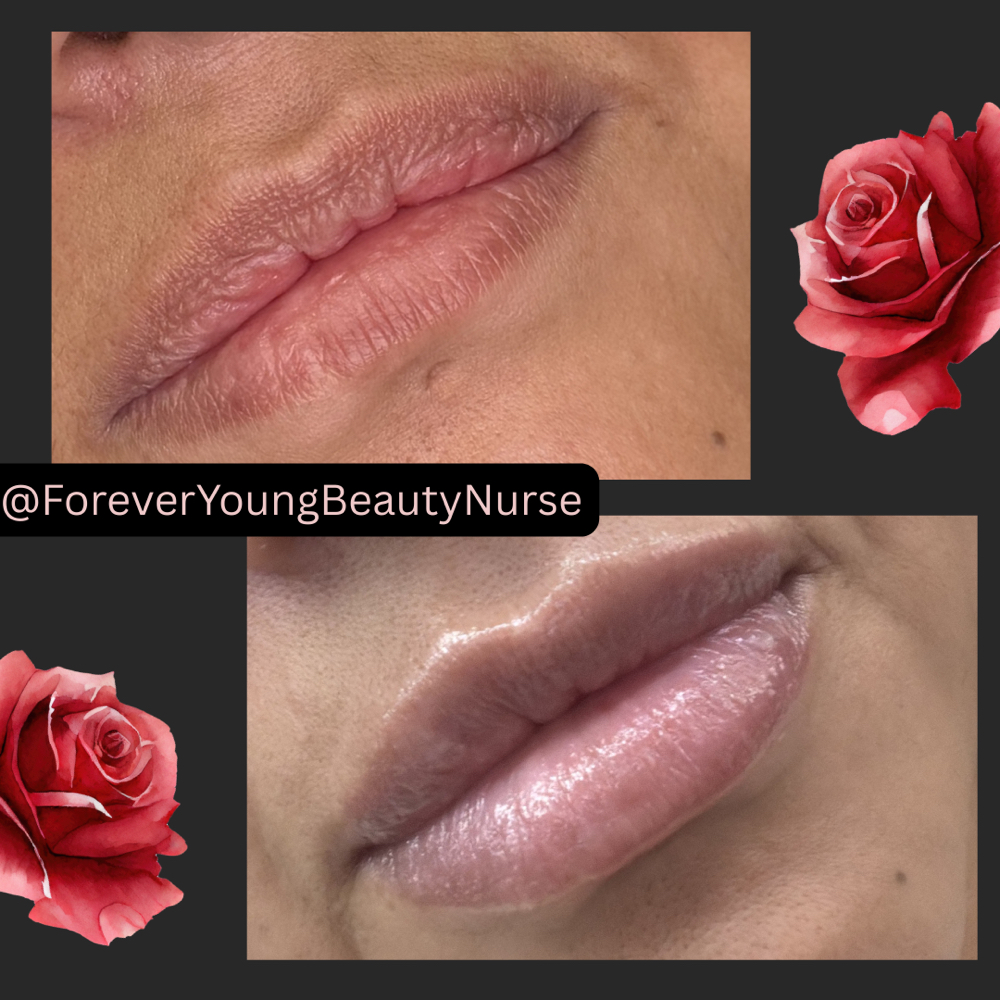 Filler Injections at Forever Young Beauty RN in Rowlett, TX