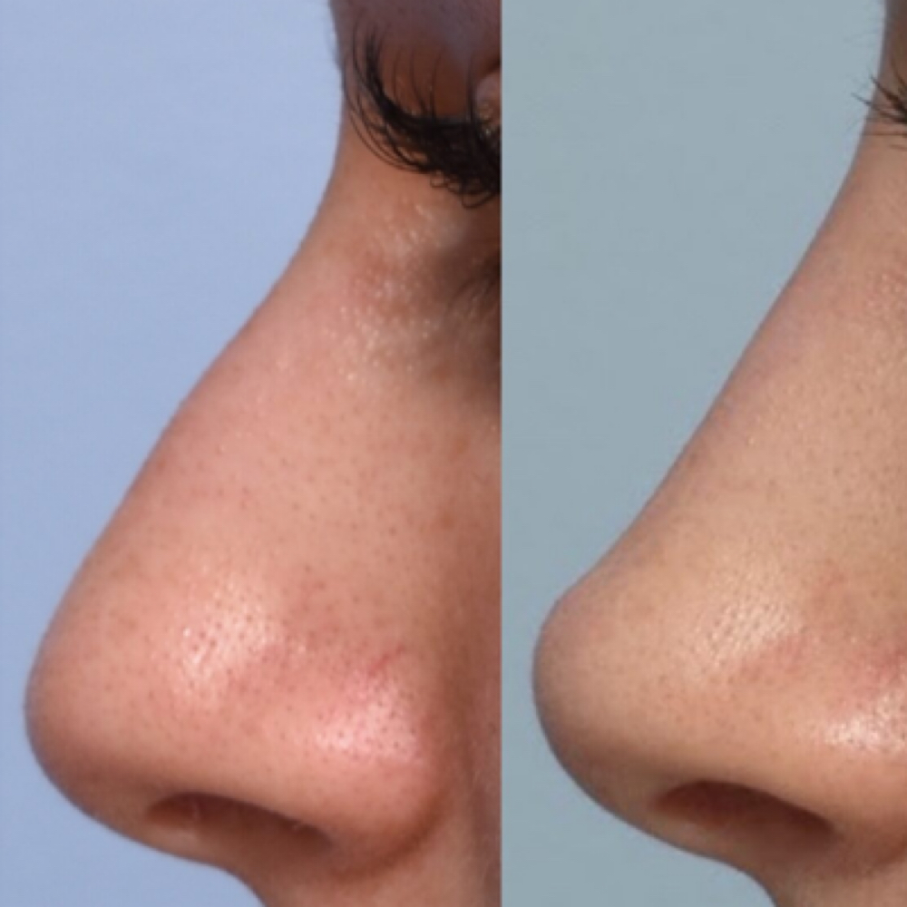 Septum Muscle Botox at Finesse Sculpt Body Studio in Parkville, MD