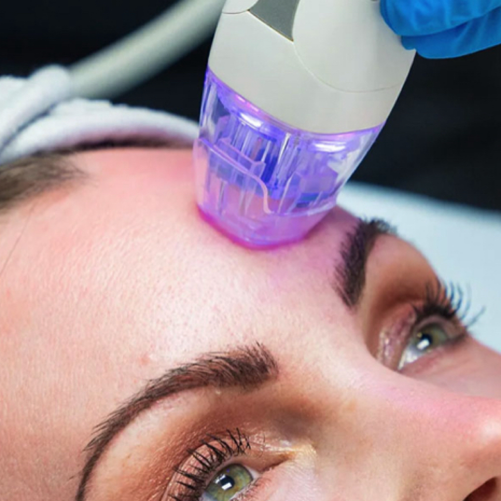 MicroNeedling RF at HOUSE OF BEAUTY UTAH in St George, UT
