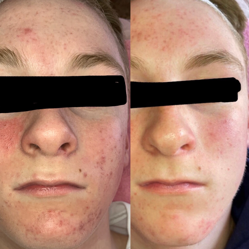 Acne Clearing Consult + Treatment