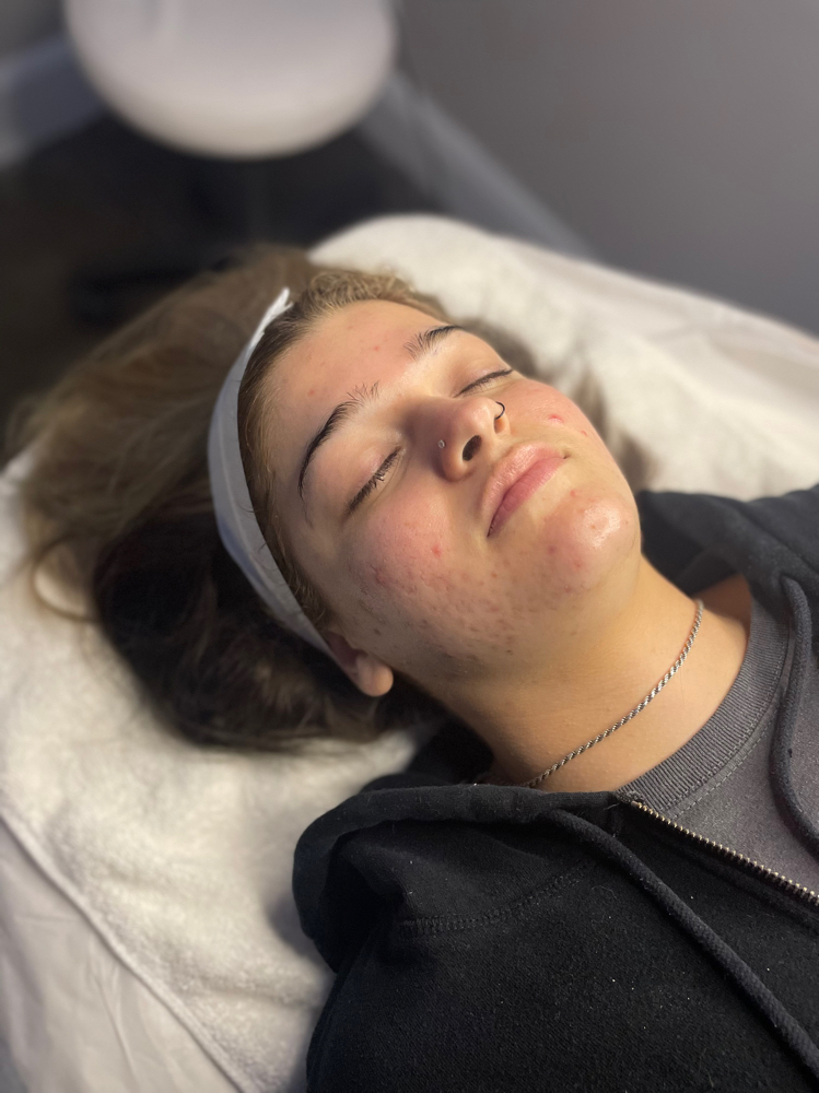Acne Facial