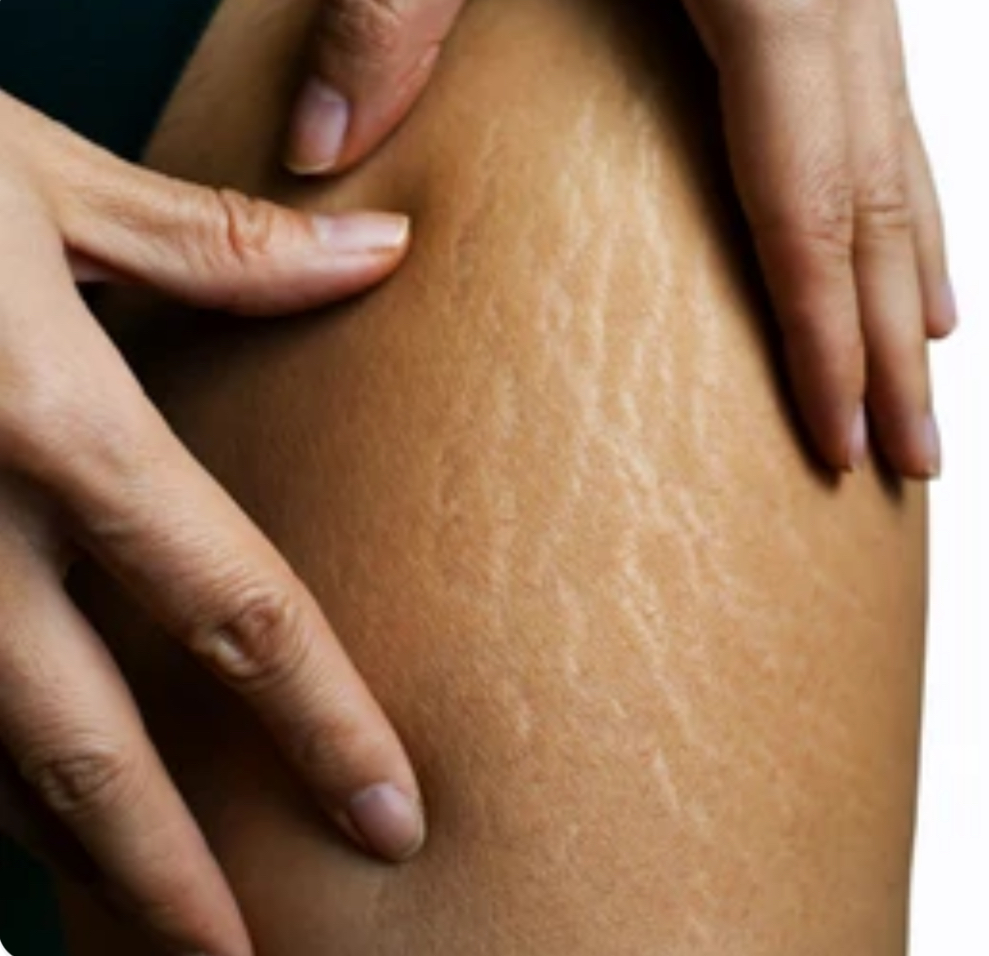 Stretch Mark Revision