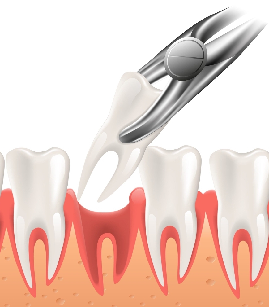 Affordable Tooth Extraction 🦷