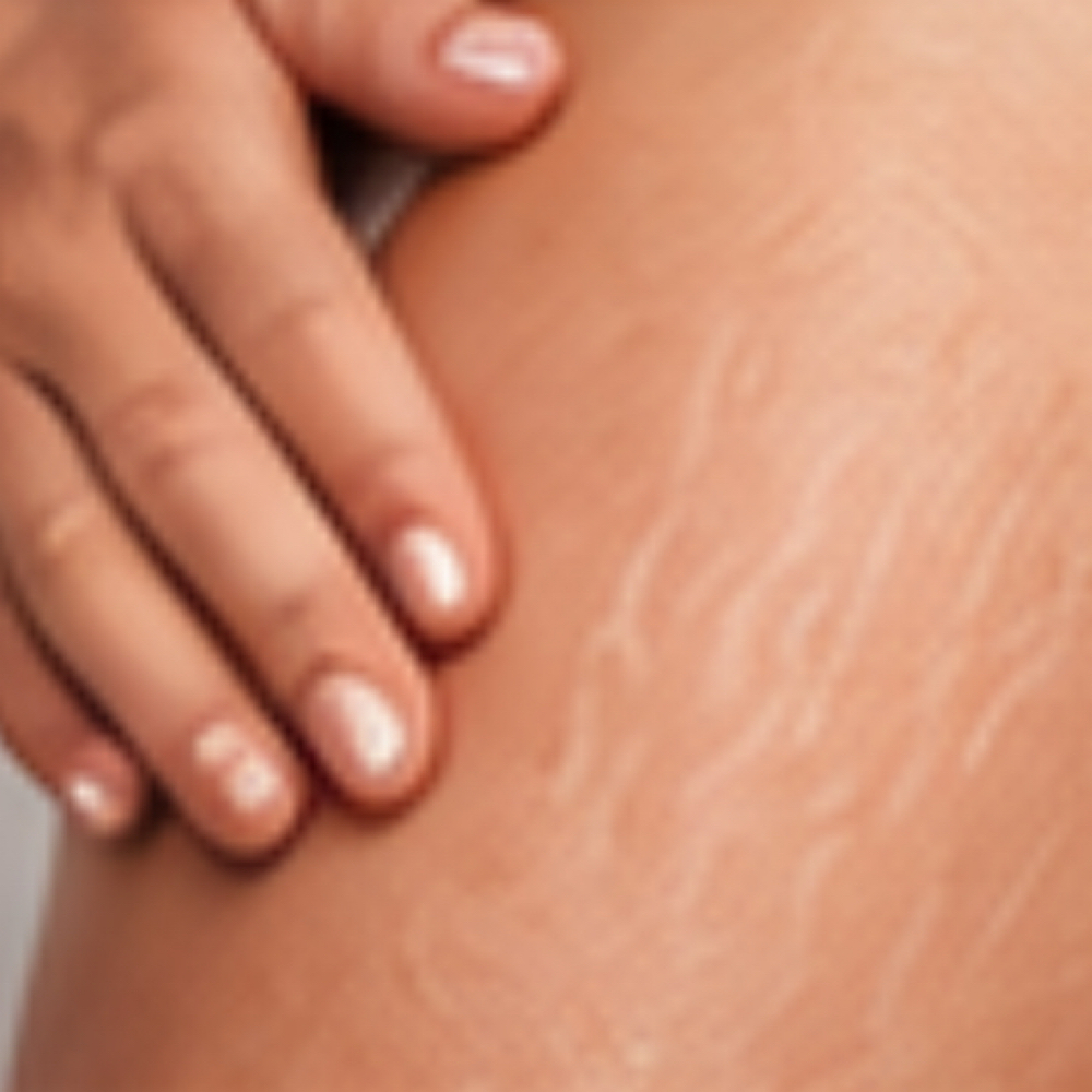 Fusion Stretch Mark Removal at Plasmalift Skin Clinic LLC in Bettendorf, IA
