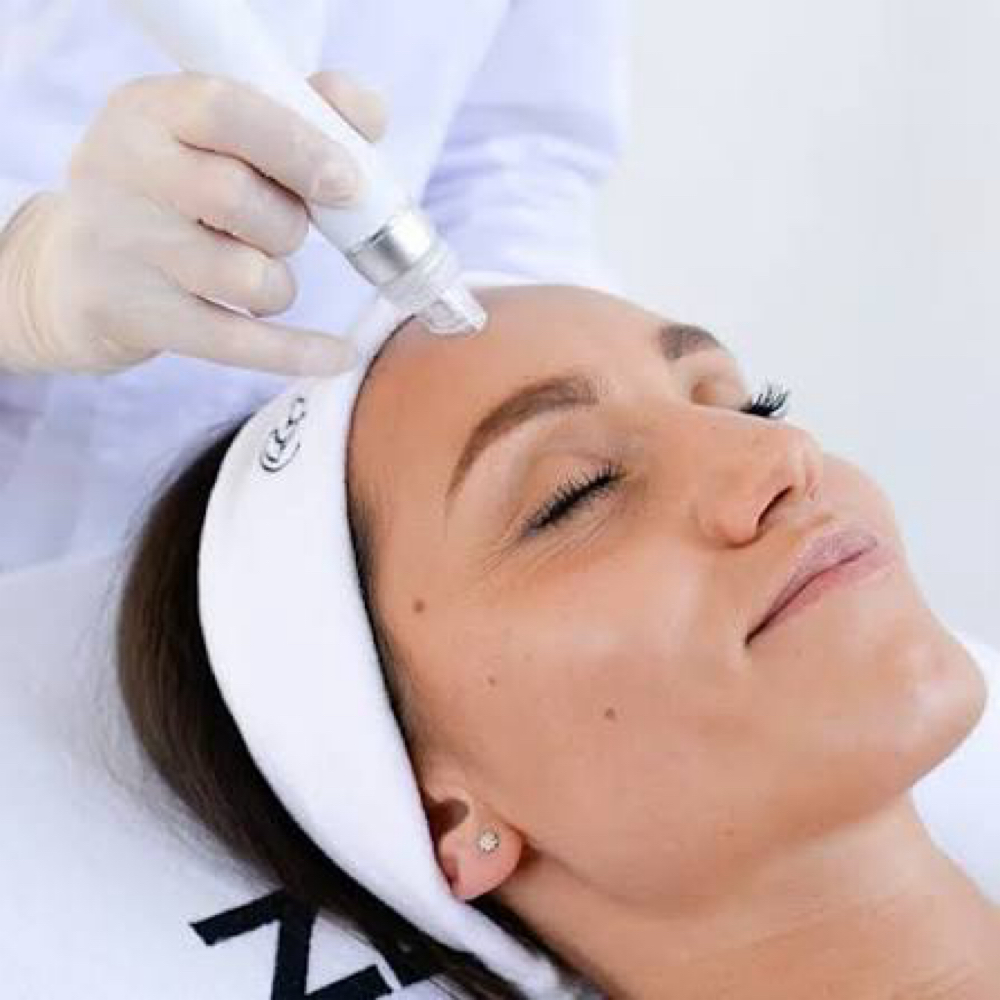 Hydro-Diamond Dermabrasion at Sculpting Beauty by Pam LLC in Atascocita, TX