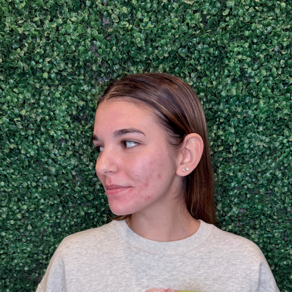Teen Acne Program Consult & Facial at Minimalist Skin Therapy in Tomball, TX