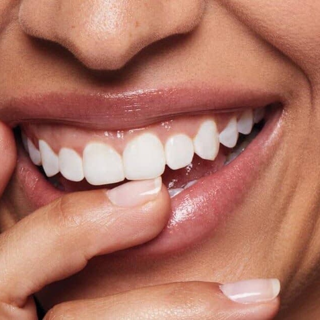 Laser Teeth Whitening at Glo Up Bar in Saratoga springs, UT