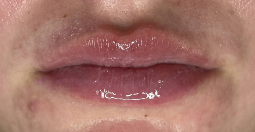 Hyaluronic Infusion Lip Treatment