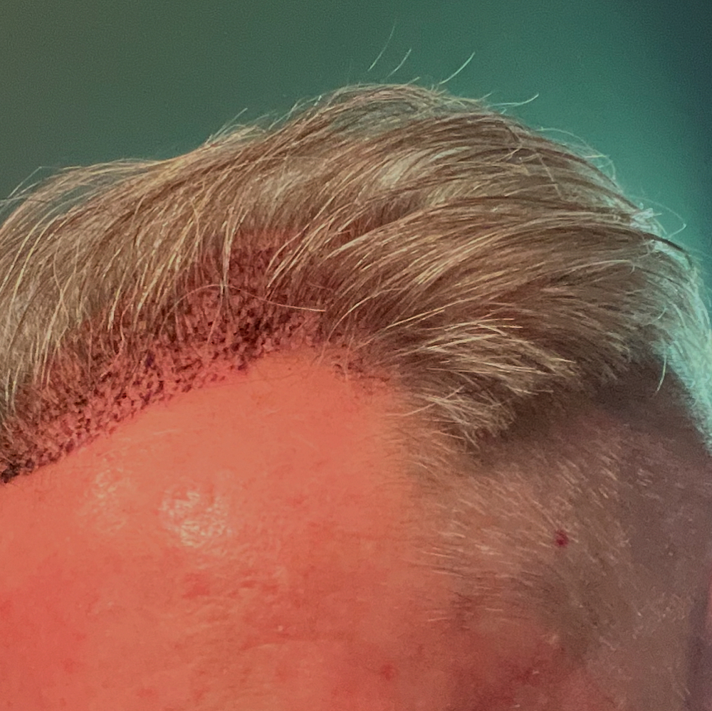 Post-Hair Transplant Haircut