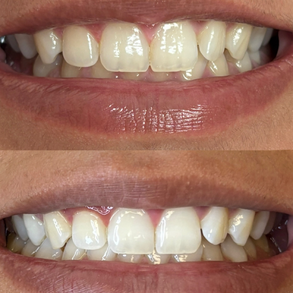 Advanced - Natural Glow at Luna Smiles in Lexington, SC