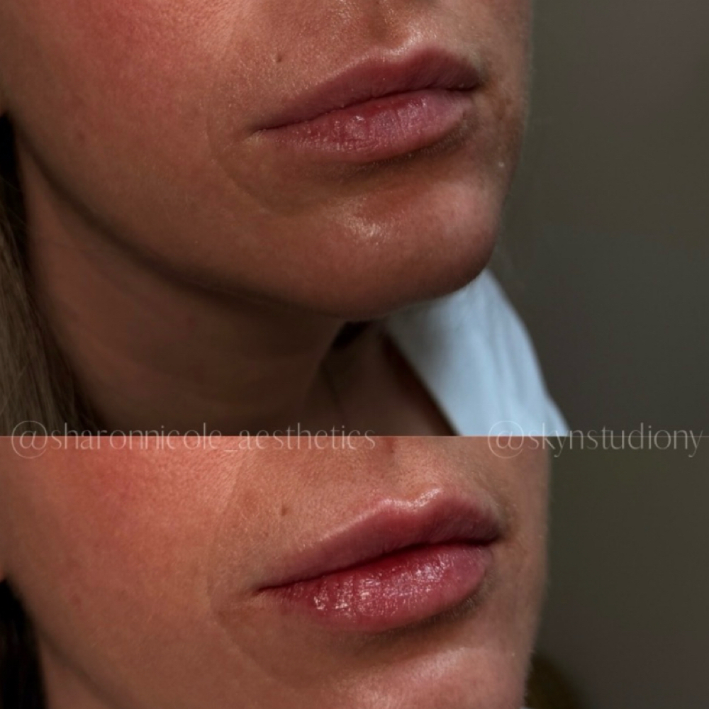 Lip Filler at Sharon Nicole Aesthetics in Patchogue, NY