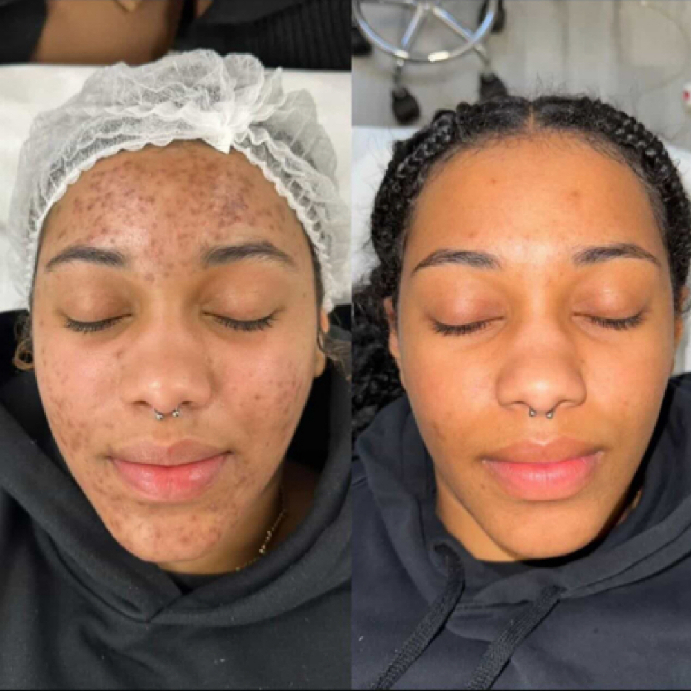 ORGANO PEEL SKIN RESET at Lumiére Skin Science in Atlanta, GA