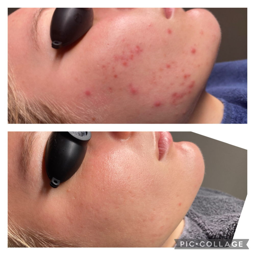 Acne Facial at MOON Organics & Esthetics in Decatur, GA