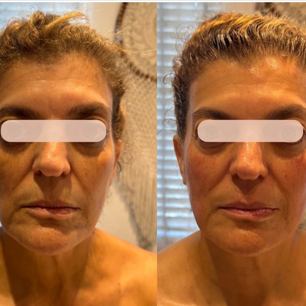 Collagen Boost at Ingrid Thompson Skincare in Beverly Hills, CA