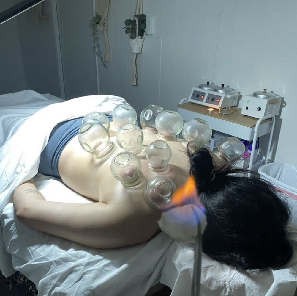 Fire Cupping
