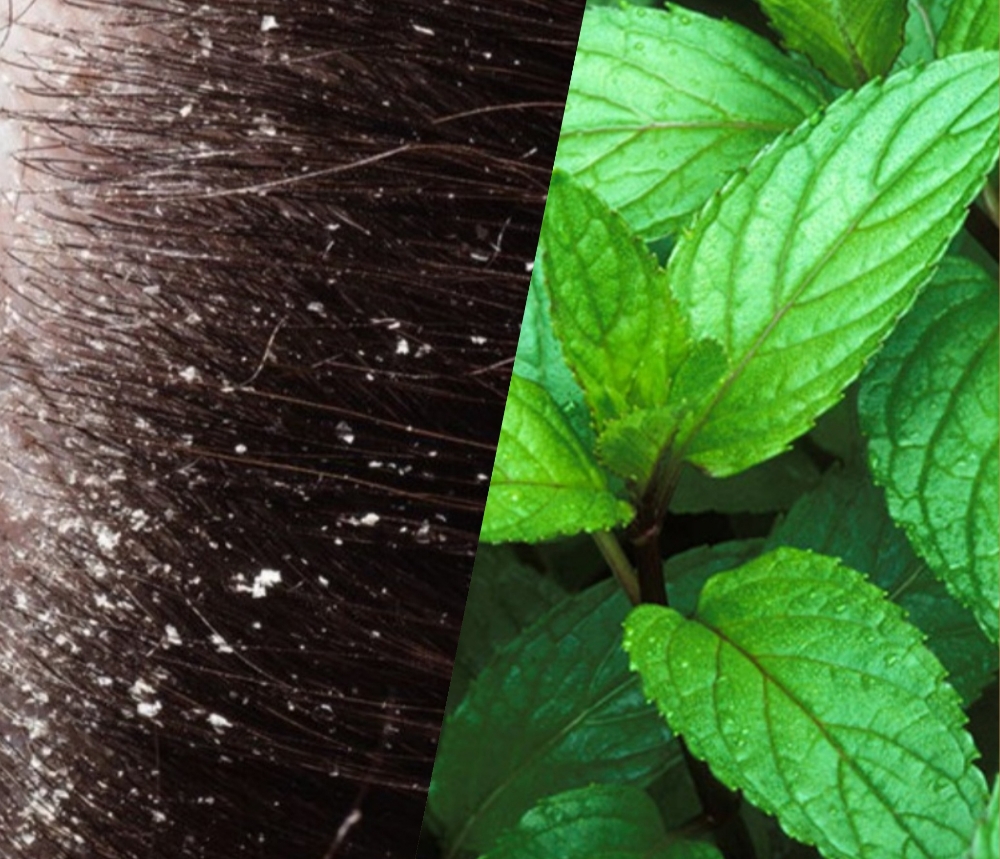 FLAKE AWAY dandruff treatment