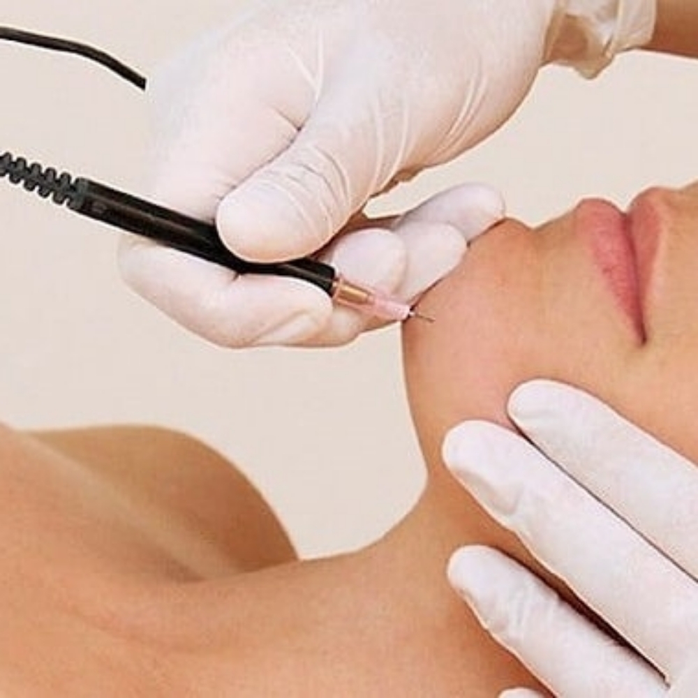 Electrolysis-Chin Area (Model) at Majestic Aesthetics by jaki in Worthington, OH