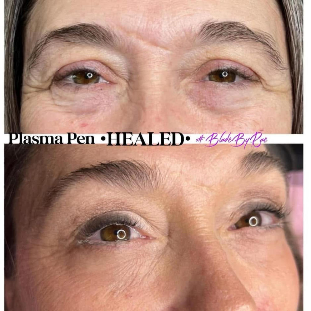 Plasma Pen Skin Tightening at Blade By Rae | Geode Spa in Clarksville, IN