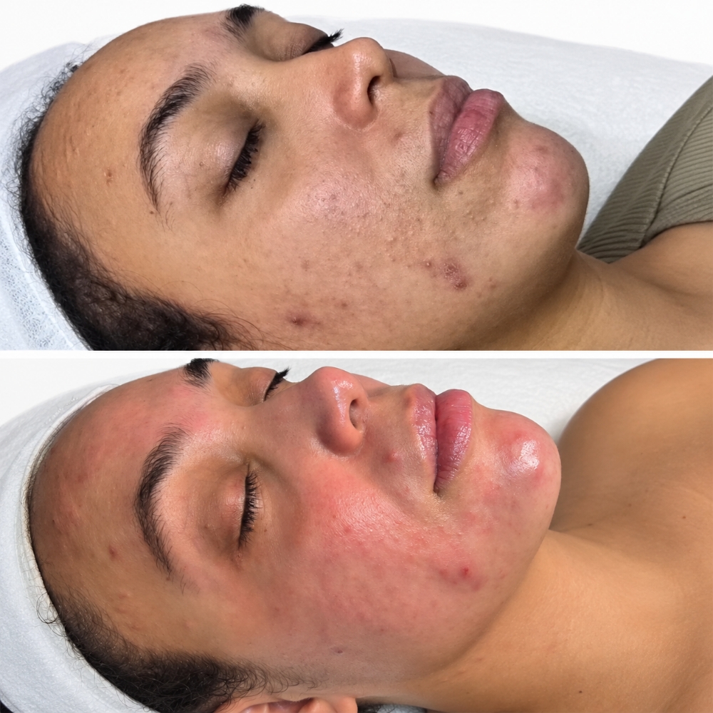 OPULENT GLOW CORRECTIVE FACIAL at Palomabeautyglow in Smithtown, NY