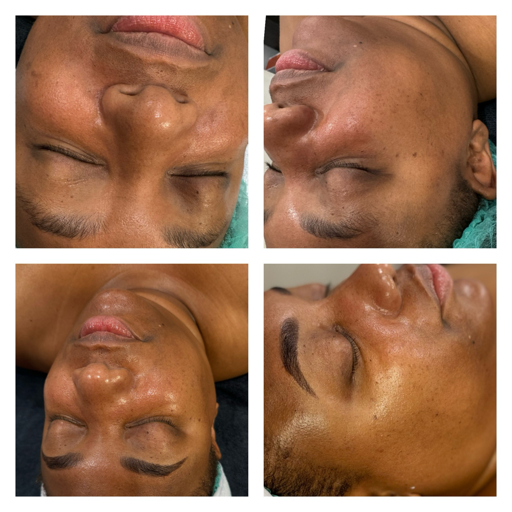 Dermaplane Facial