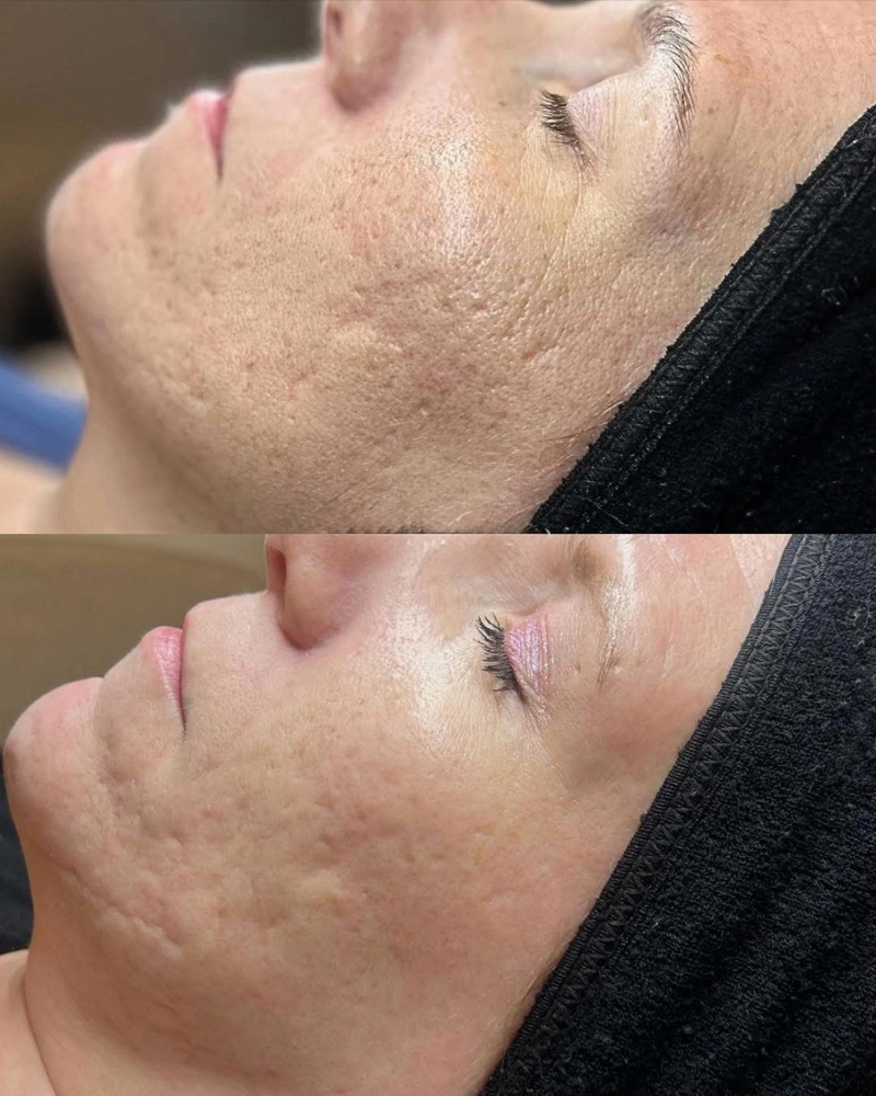 Stem Cell Regeneration Treatment