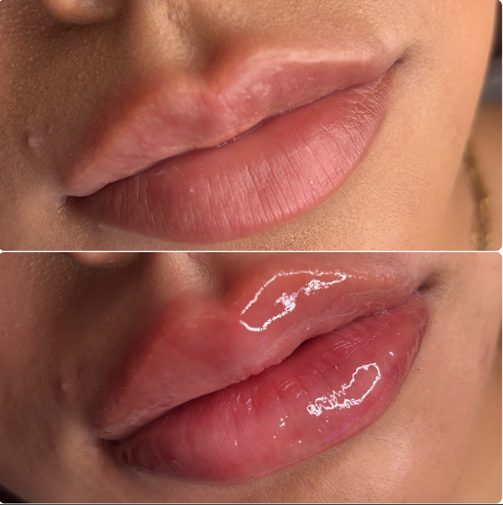 2ML Lip Filler