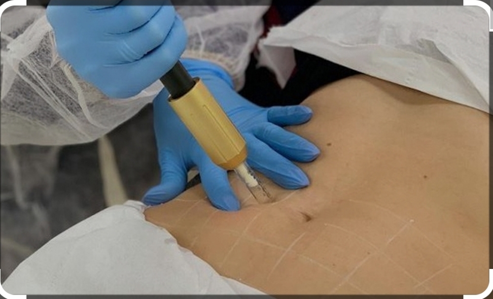 (6) Fat Dissolve Skin Infusions
