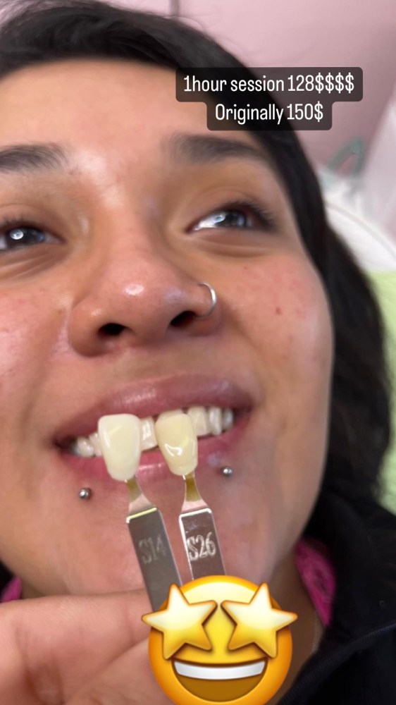 80 Minutes Teeth Whitening Session
