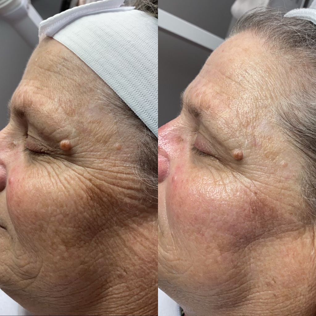 Anti Aging Lift Treatment