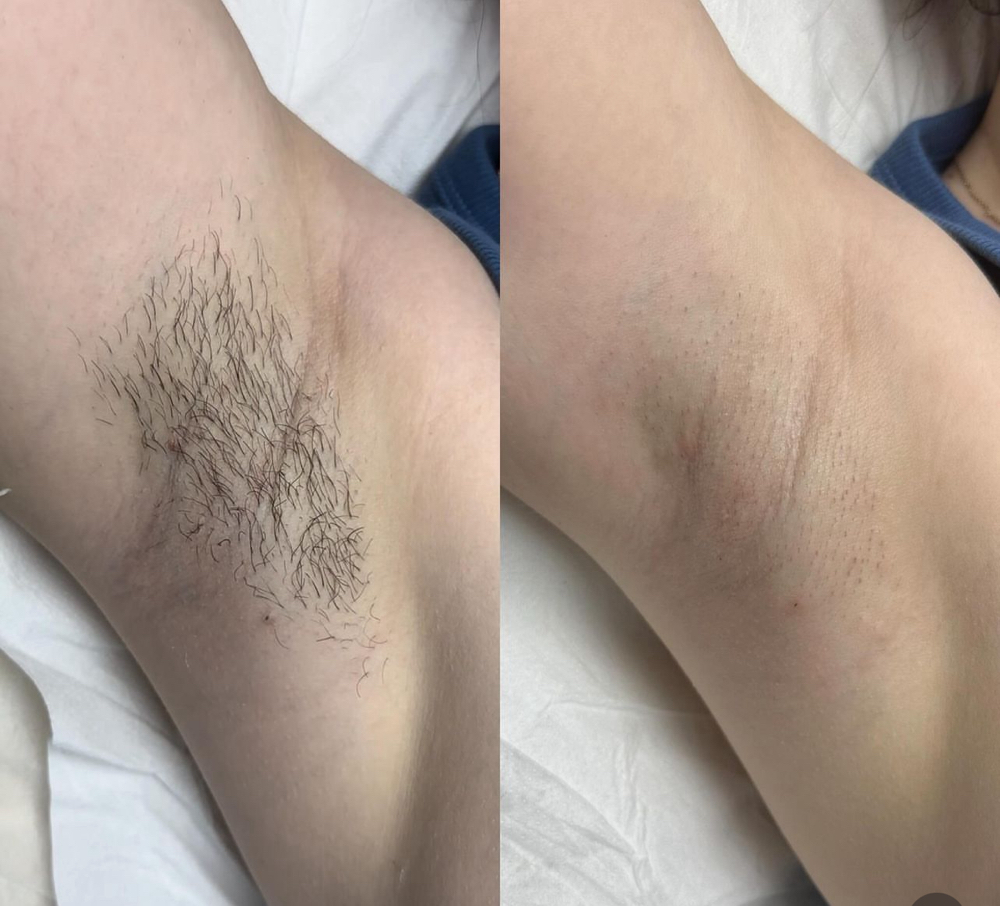 Underarms Wax