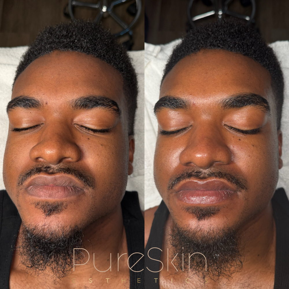 $50 Facial Special 4/7-4/21 at Pure Skin Esthetics in Daytona Beach, FL