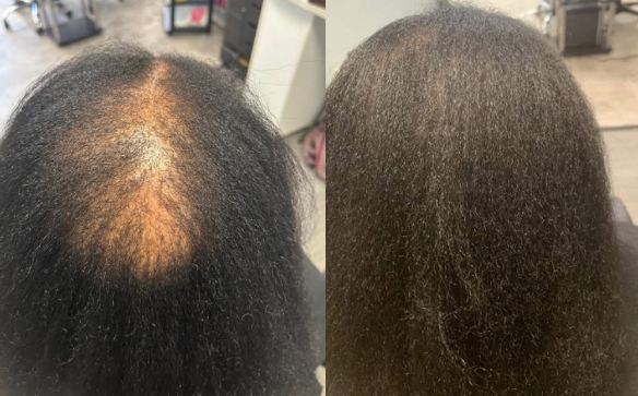 Hair Restoration Treatment at Royal Throne in Raleigh, NC
