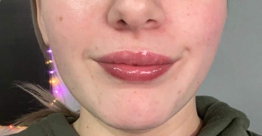 3ml Lip Filler