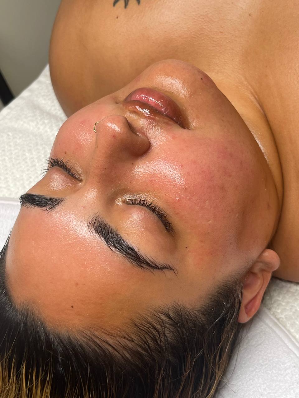 PIGMENTATION FACIAL