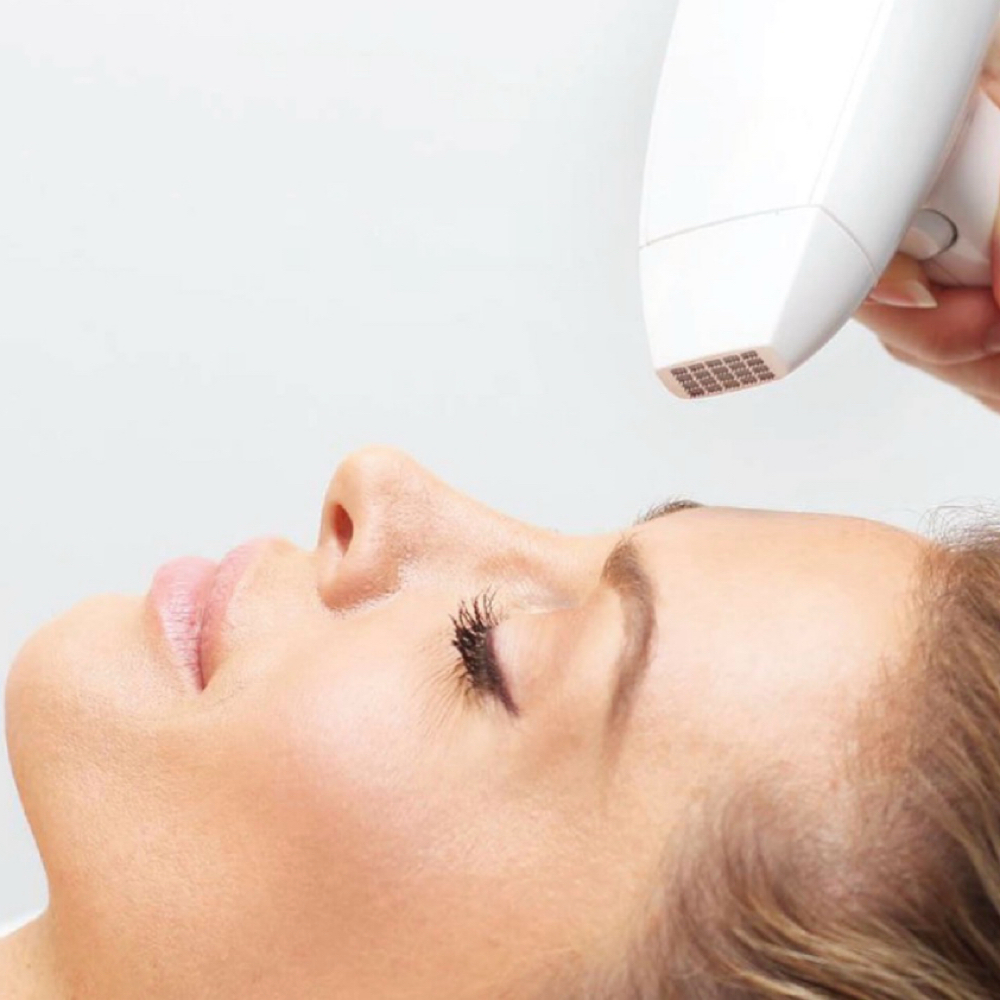 Laser Resurfacing/ Consult at 227 Aesthetics in Sterling Heights, MI