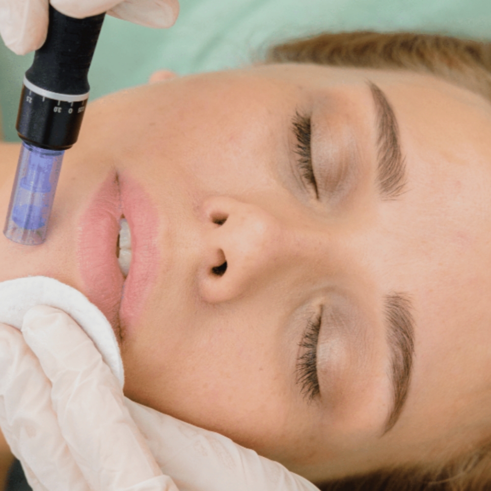 Collagen Induction Therapy at Boujee Asthetics ✨ in Tucson, AZ