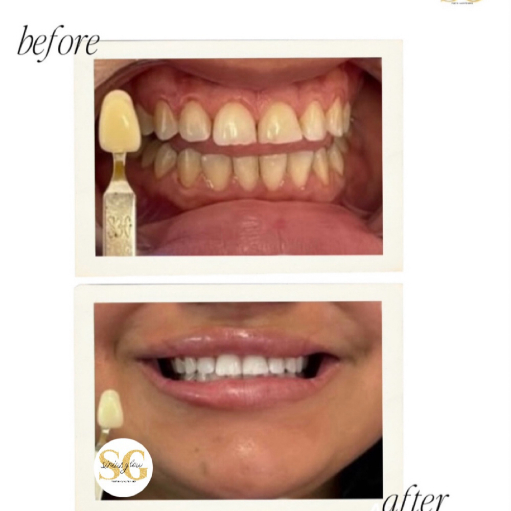 Heavy Treatment▫️two clients at Sirius Glow Teeth Whitening in Pasadena, TX