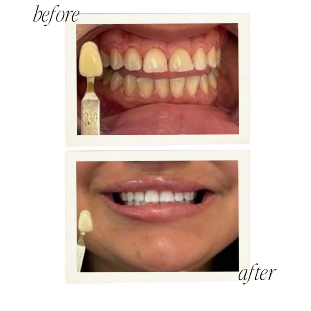 Heavy Treatment▫️two clients at Sirius Glow Teeth Whitening in Pasadena, TX